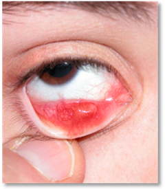 Stye Chalazion 2
