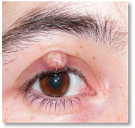 Stye Chalazion 3