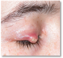 Stye Chalazion 4