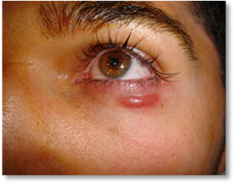 Stye Chalazion 5