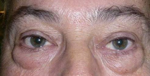 Blepharoplasty 1