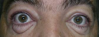 Blepharoplasty 2