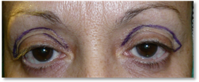 Blepharoplasty 3