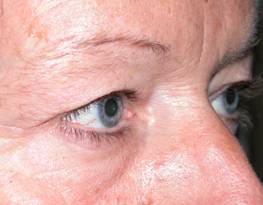 Blepharoplasty 6