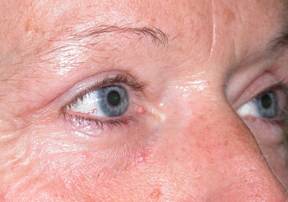 Blepharoplasty 7