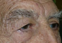 Blepharoplasty 8
