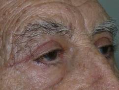 Blepharoplasty 9