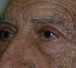 Blepharoplasty 11