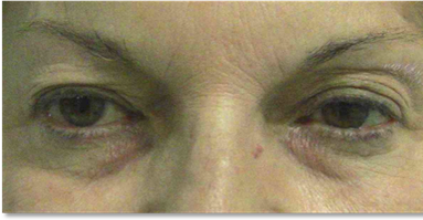 Blepharoplasty 12