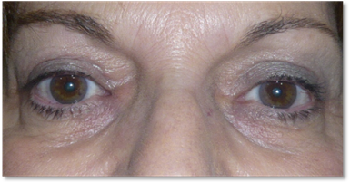Blepharoplasty 13