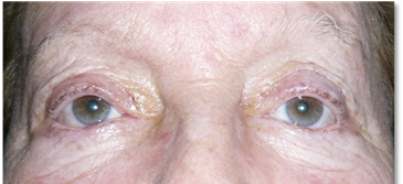 Blepharoplasty 15