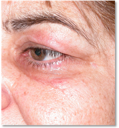 Blepharoplasty 16