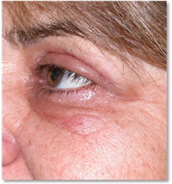 Blepharoplasty 17