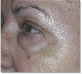 Blepharoplasty 18