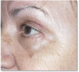 Blepharoplasty 19