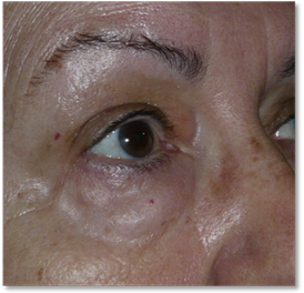 Blepharoplasty 20