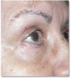 Blepharoplasty 21