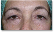 Blepharoplasty 24