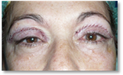 Blepharoplasty 25