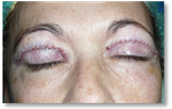 Blepharoplasty 26