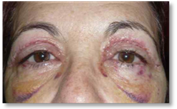 Blepharoplasty 27