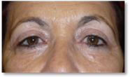 Blepharoplasty 28