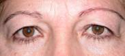 Blepharoplasty 29
