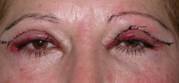 Blepharoplasty 30