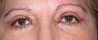 Blepharoplasty 31