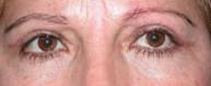 Blepharoplasty 32
