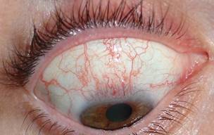 Pterigium pingu&eacute;cula 2