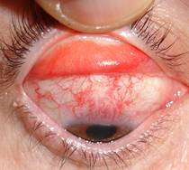 Pterigium pingu&eacute;cula 3