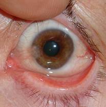 Pterigium pingu&eacute;cula 4