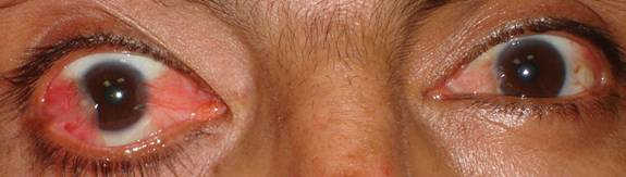 Pterigium pingu&eacute;cula 6