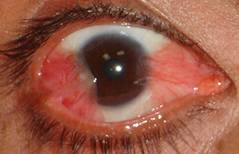 Pterigium pingu&eacute;cula 8