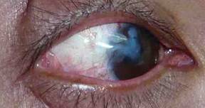 Pterigium pingu&eacute;cula 9