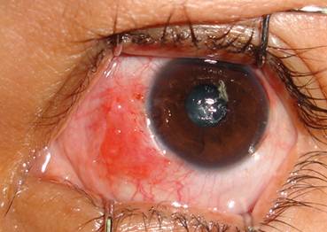 Pterigium pingu&eacute;cula 10