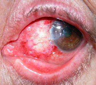 Pterigium pingu&eacute;cula 11