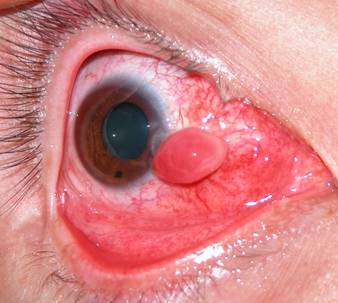 Pterigium pingu&eacute;cula 12