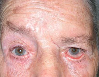 Ptosis de ceja 1