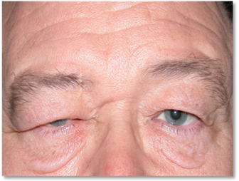 Ptosis de ceja 2