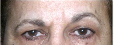 Ptosis de ceja 3