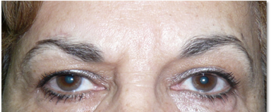 Ptosis de ceja 4