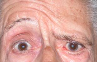 Ptosis de ceja 10