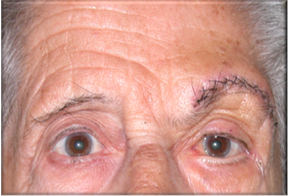 Ptosis de ceja 11