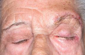 Ptosis de ceja 12