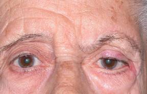 Ptosis de ceja 13