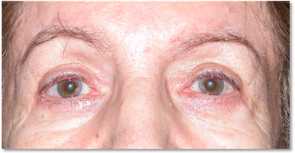 Ptosis de ceja 15