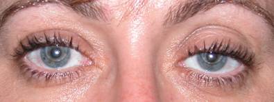 Eyelid ptosis 1
