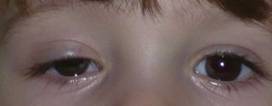 Eyelid ptosis 2